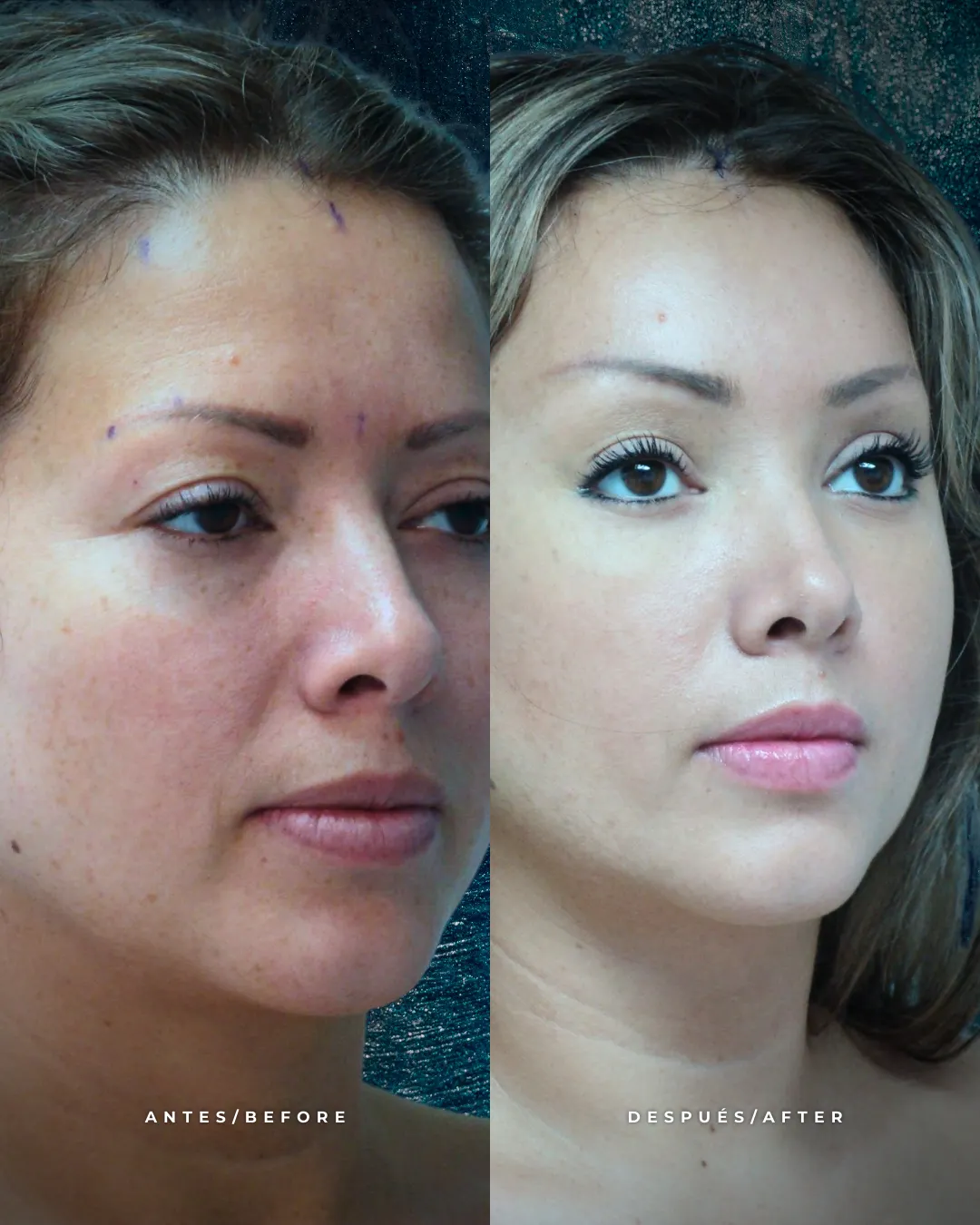 Comparativa de antes y después de blefaroplastia en Cali. Resultados de cirugía de párpados para eliminar bolsas, ojeras y exceso de piel en la mirada, realizada por especialista en cirugía plástica.