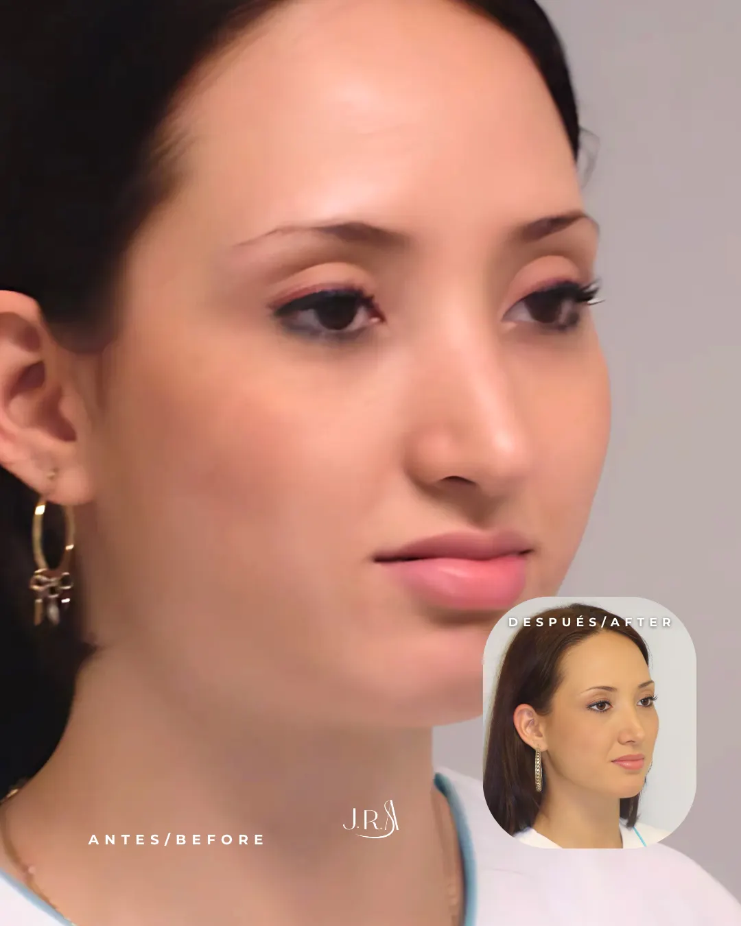 Antes y después de cirugía de nariz en Cali. Mejora del perfil nasal y armonía facial con el Dr. Jaime Arias.