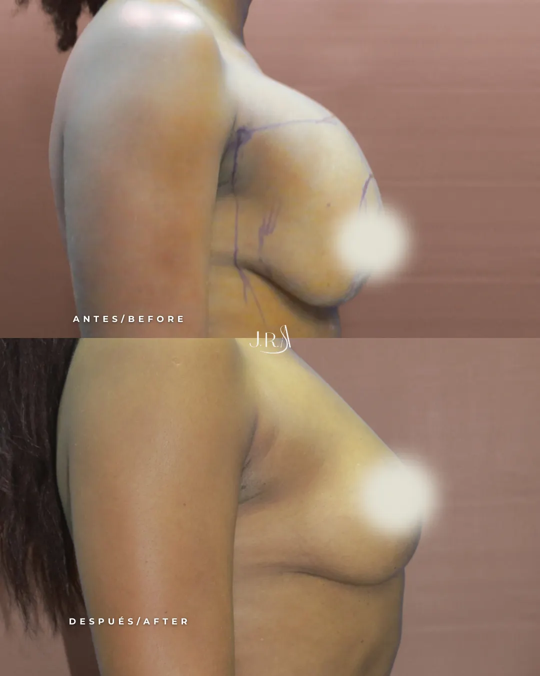 Explantación Mamaria Cali - Retiro de Implantes de Seno Antes y Después Dr. Arias Comparativa de antes y después de explantación mamaria y capsulectomía total en Cali, Colombia, realizada por el Dr. Jaime Roberto Arias. Muestra el retiro completo de implantes de seno y la cápsula periprotésica, mejorando la salud y el contorno natural del busto.