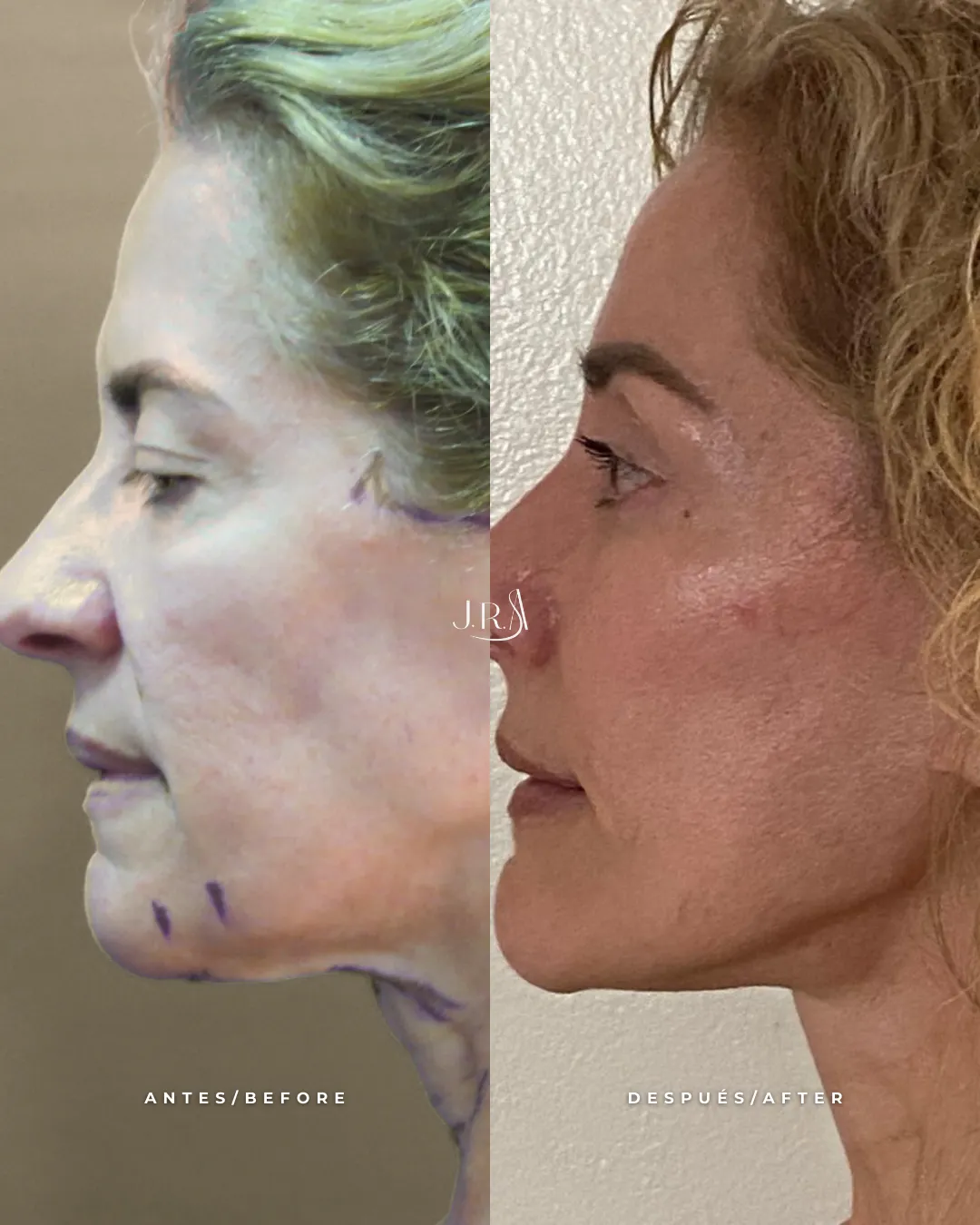 Comparativa de antes y después de lifting facial o ritidoplastia en Cali, Colombia, realizada por el Dr. Jaime Roberto Arias. Muestra resultados de rejuvenecimiento facial en perfil, con corrección de flacidez en mejillas, mandíbula y cuello.