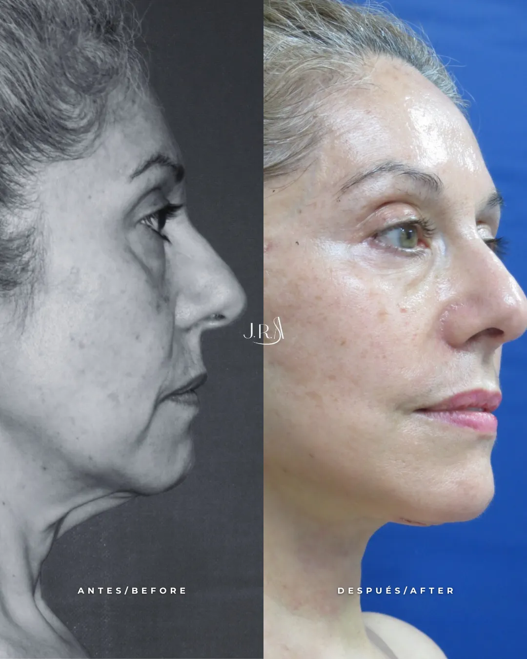 Comparativa de antes y después de lifting facial o ritidoplastia en Cali, Colombia, realizada por el Dr. Jaime Roberto Arias. Muestra resultados de rejuvenecimiento facial en perfil, con corrección de flacidez en mejillas, mandíbula y cuello.
