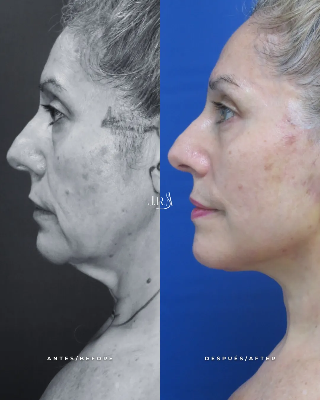 Vista de perfil de antes y después de lifting facial y cervical en Cali, Colombia. Se observa la eliminación de papada y el tensado de la línea mandibular realizado por el Dr. Jaime Roberto Arias.