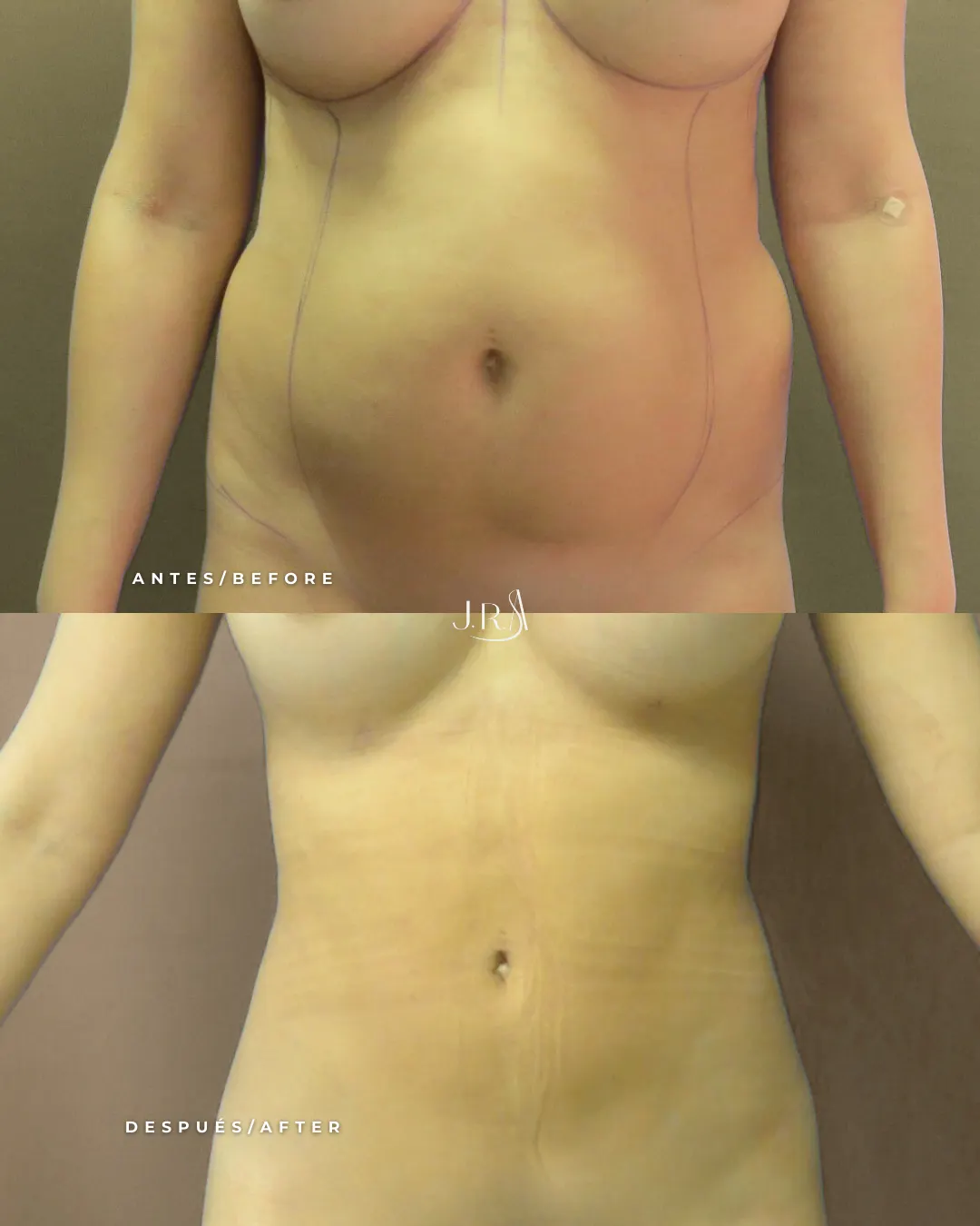 Comparativa de antes y después de lipoescultura o liposucción de alta definición en Cali, Colombia, realizada por el Dr. Jaime Roberto Arias. Muestra la reducción de grasa localizada en abdomen y cintura, logrando un contorno corporal definido.