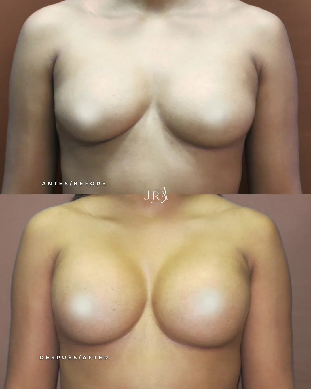 Comparativa frontal de antes y después de mamoplastia de aumento vía axilar en Cali. Resultados naturales de aumento de busto con implantes, sin cicatrices en el seno, realizados por el Dr. Jaime Arias.
