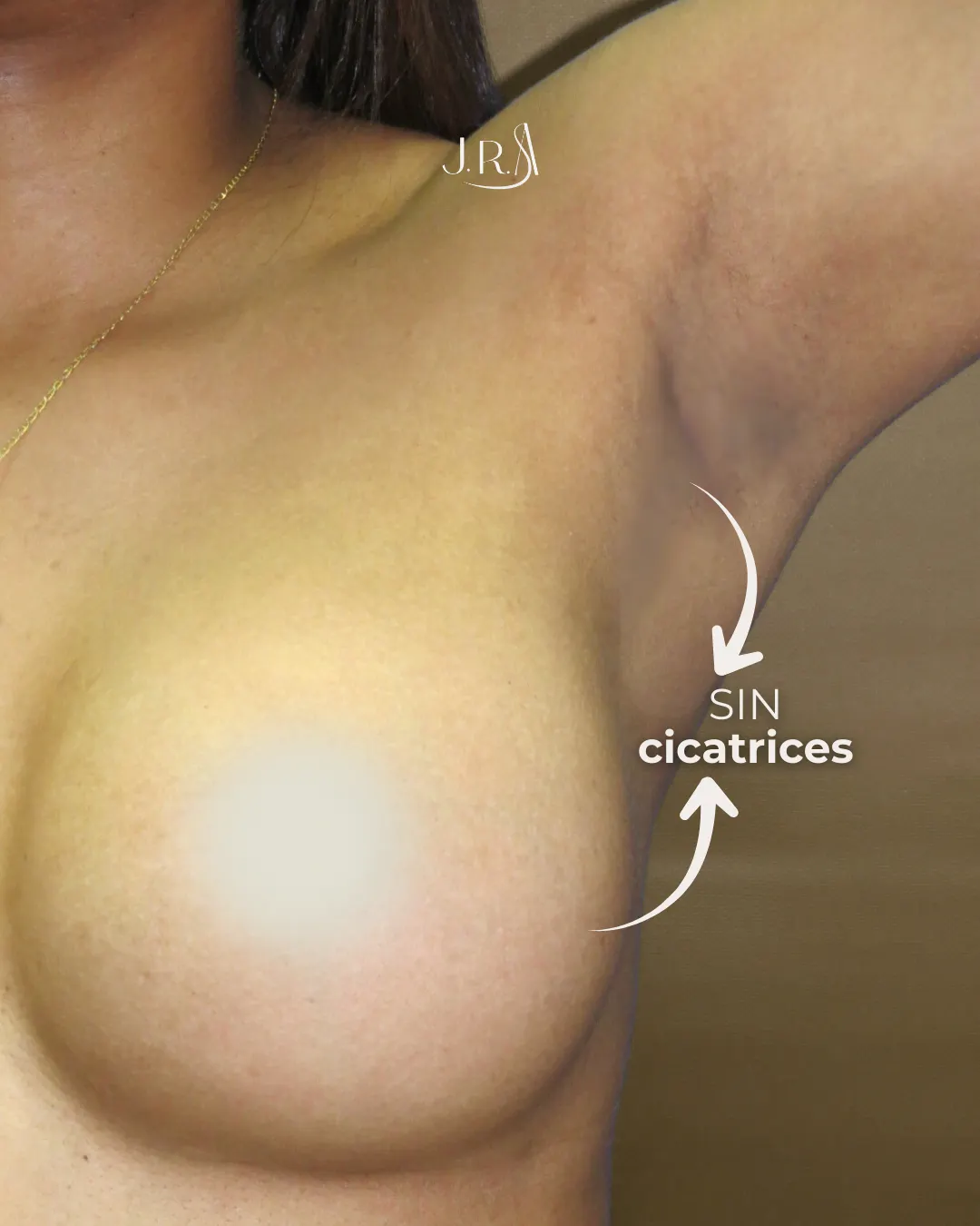 Comparativa de antes y después de mamoplastia de aumento vía axilar en Cali, Colombia, realizada por el Dr. Jaime Arias. Muestra el incremento de volumen mamario y la ausencia total de cicatrices visibles en el busto tras la colocación de implantes de silicona.