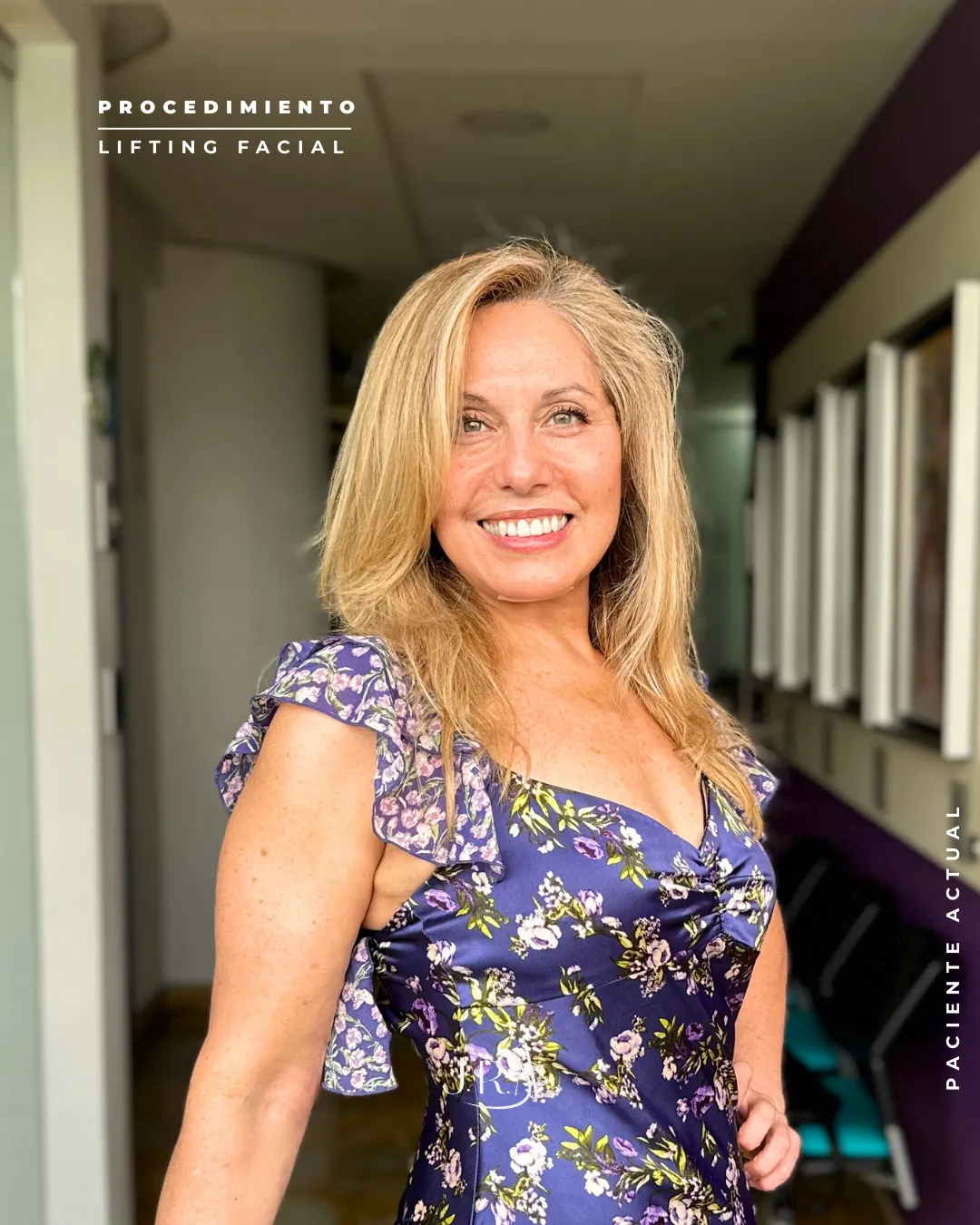 Paciente feliz en Cali, Colombia, tras rejuvenecimiento facial con lifting. Resultado natural de ritidoplastia en nuestra clínica experta en cirugía plástica.