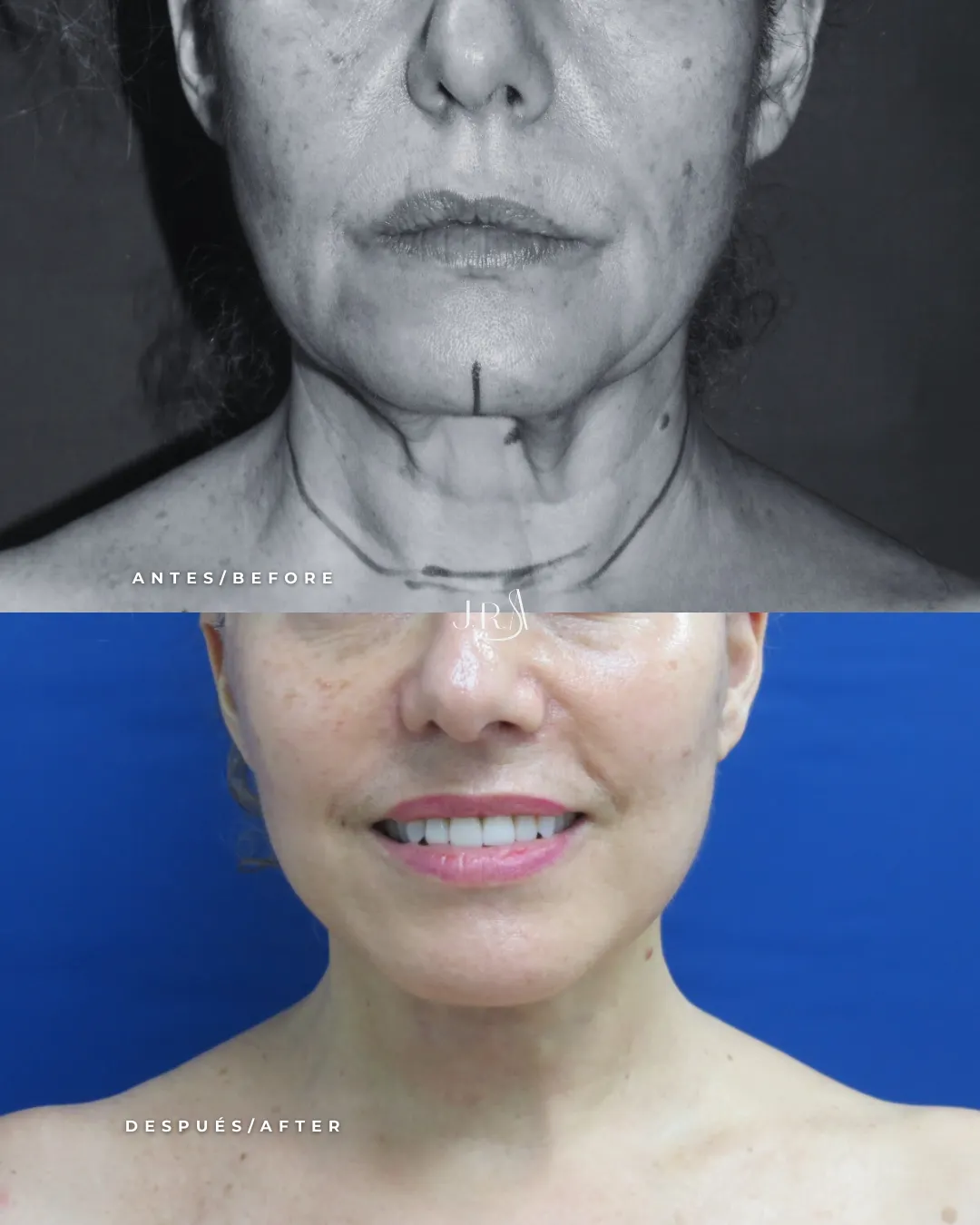 Antes y después de lifting facial en Cali. Definición de mandíbula y cuello con el Dr. Jaime Arias.