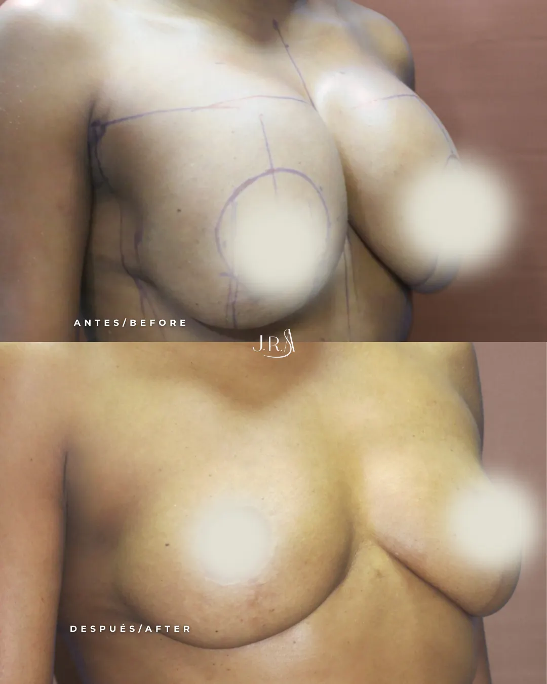 etiro de Implantes Mamarios Cali Antes y Después Antes y después de explantación mamaria en Cali. Retiro de prótesis y levantamiento de senos con el Dr. Jaime Arias.