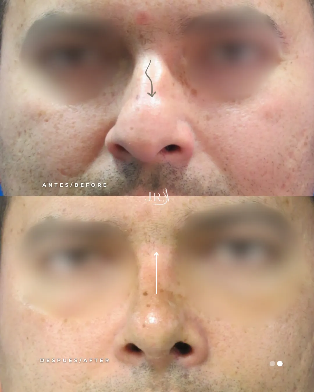Antes y después de rinoplastia funcional en hombre en Cali. Mejora de simetría y desviación con el Dr. Jaime Arias.