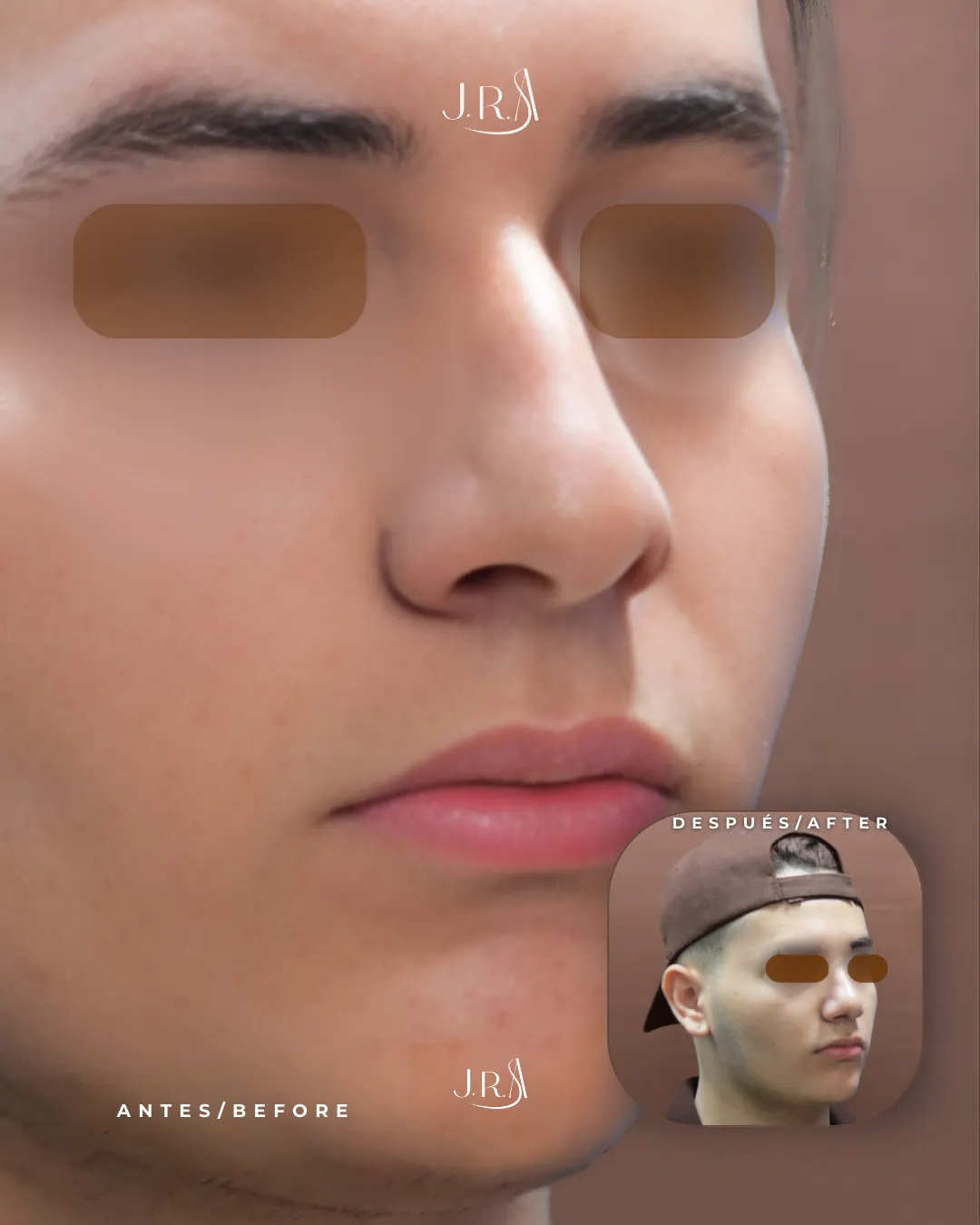 Antes y después de rinoplastia masculina en Cali. Mejora en la proyección nasal y perfil más armónico en hombre con el Dr. Jaime Arias.
