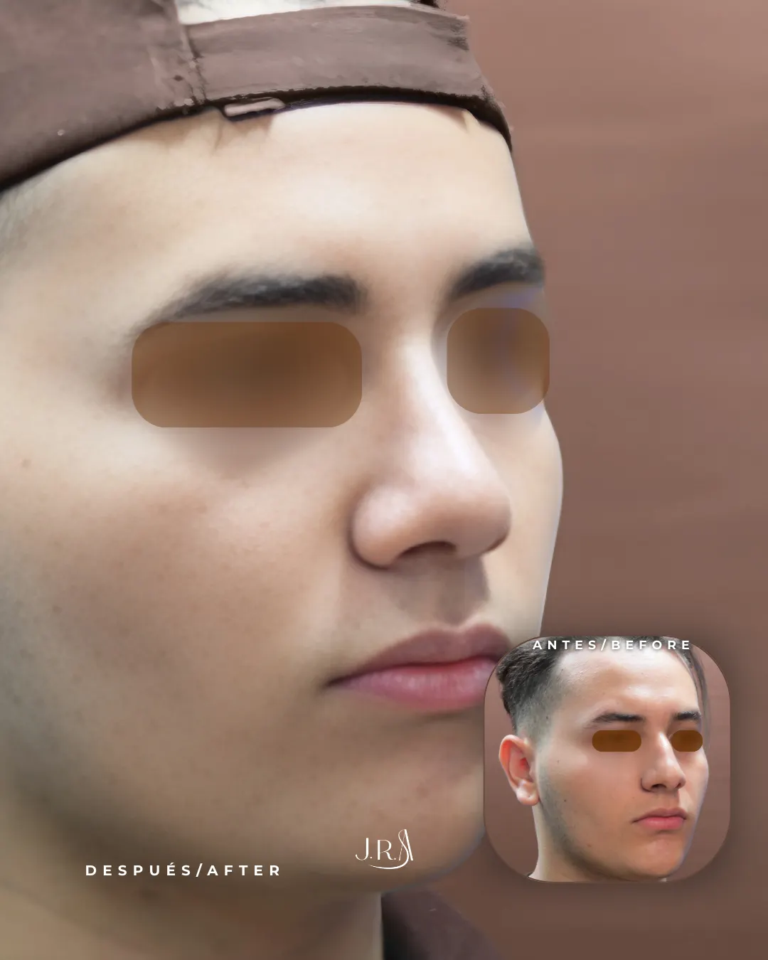 Antes y después de rinoplastia masculina en Cali. Mejora del perfil nasal y definición de la punta con el Dr. Jaime Arias.