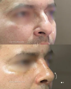 Antes y después de rinoplastia natural en Cali. Mejora en la forma nasal y perfil más armónico en hombre con el Dr. Jaime Arias.