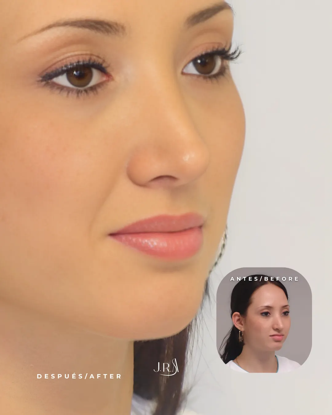 Antes y después de rinoplastia femenina en Cali. Perfil nasal refinado y punta definida con el Dr. Jaime Arias.
