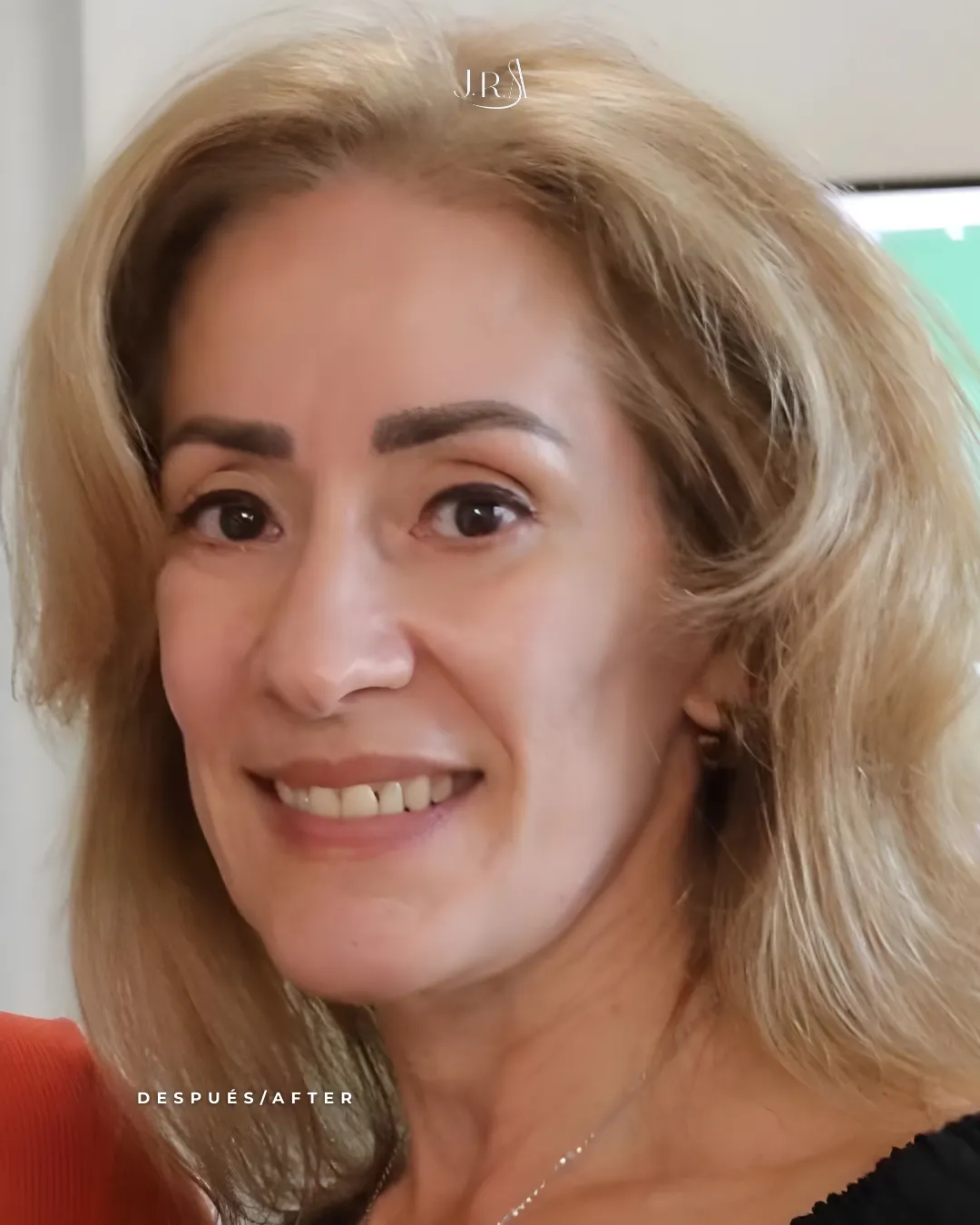 Imagen comparativa de antes y después de cirugía de nariz en Cali, Colombia. Se observa mejoría en la proyección del dorso nasal y la definición de la punta, logrando un resultado equilibrado, femenino y natural. Procedimiento realizado por el Dr. Jaime Arias.