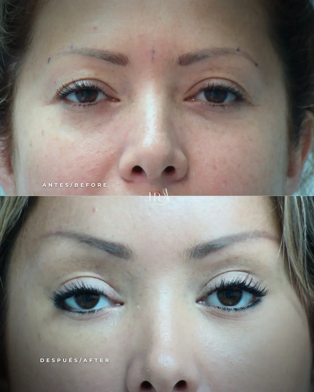 Antes y después de blefaroplastia frontal en Cali. Eliminación de exceso de piel en párpados con el Dr. Jaime Arias.